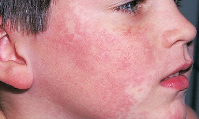 “Tokatlanmış yanak” sendromu hastalığı nedir