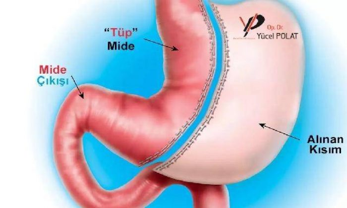 Mide küçültme ameliyatlarının anlatılmayan zararları