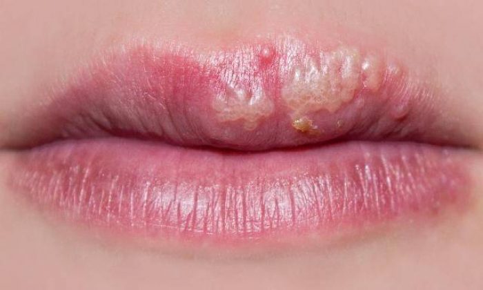 Aft yaralarını 1 saat içerisinde geçiren yöntem